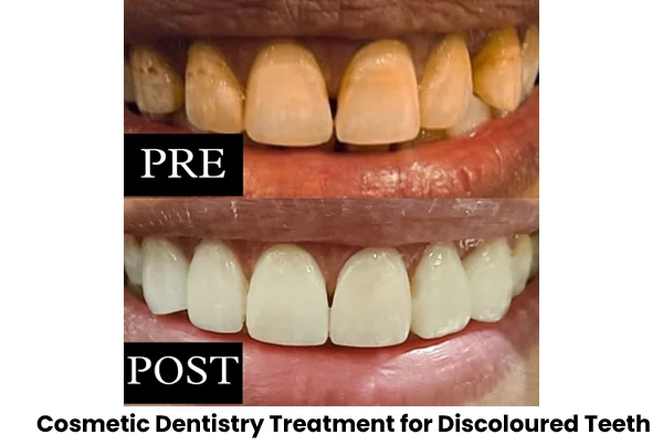 Pre and Post