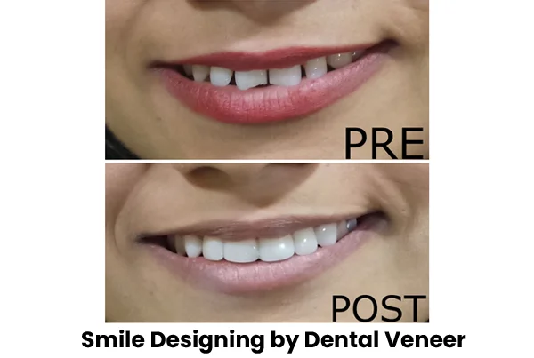 Pre and Post