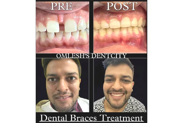 Pre and Post
