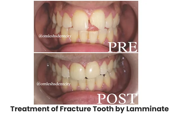 Pre and Post