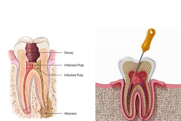 Single Sitting Painless Root Canal Treatment