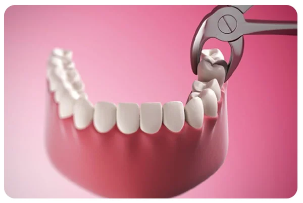 Surgical Extraction