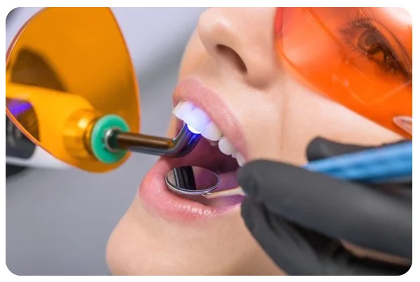 Laser Filling