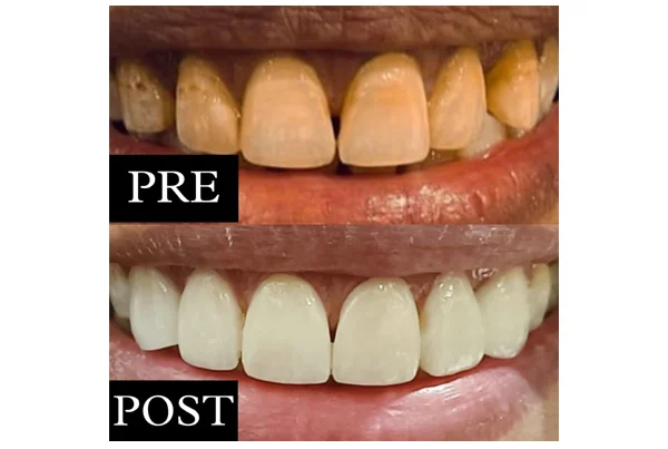 Dental Veneers and Laminates