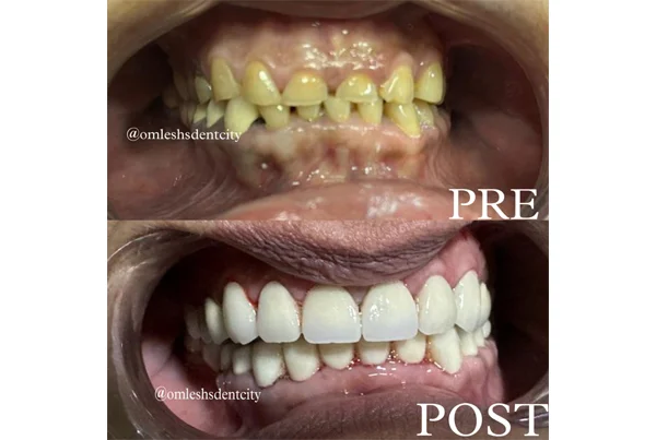 Full Mouth Rehabilitation