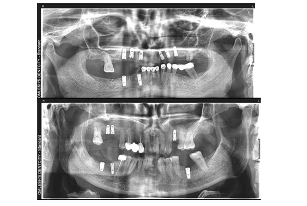 Dental Implants