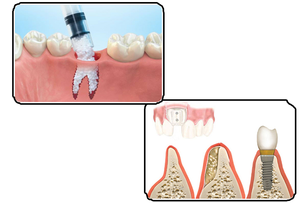 Bone Grafting and Bone Regeneration