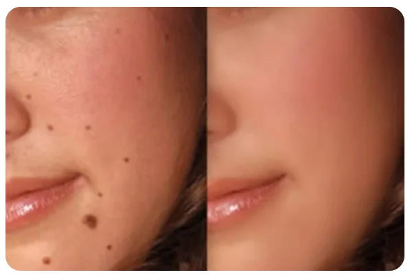 Mole, Warts and Tag Removal