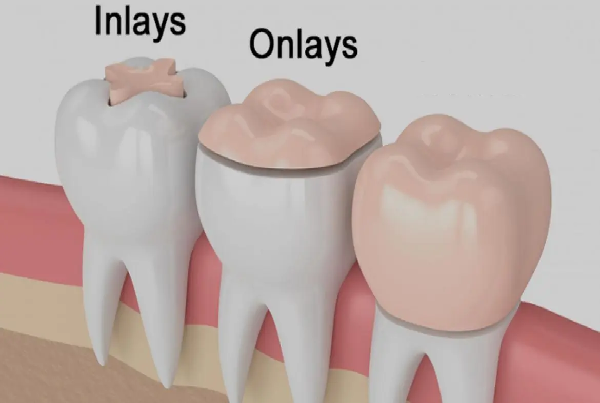 Onlays and Inlays