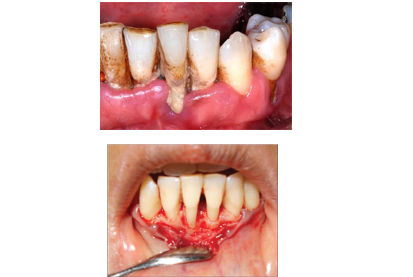 Gum Disease Treatment