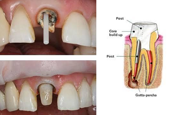 Post and Core Build Up